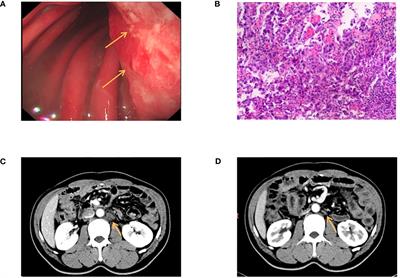 Targeted therapy for multiple gene mutations in multiple metastases of advanced gastric cancer: a case report